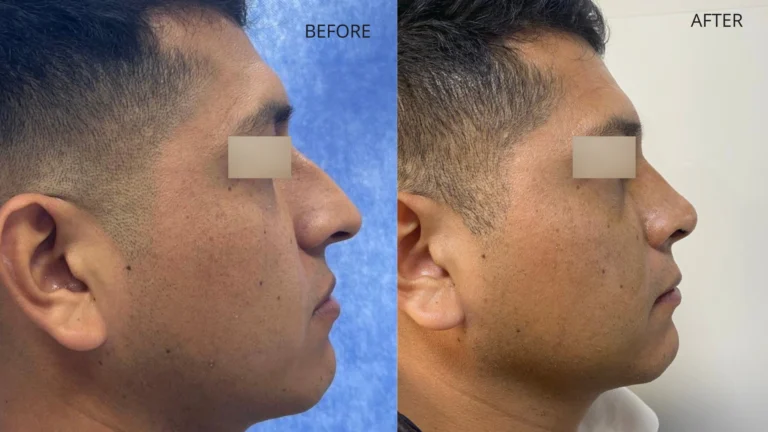 Testimonio rinoplastia