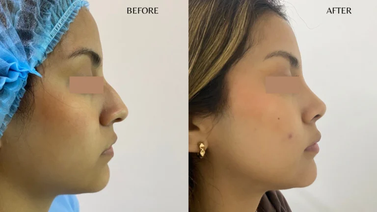 Testimonio rinoplastia