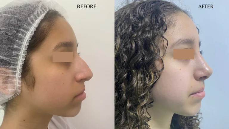 Testimonio rinoplastia